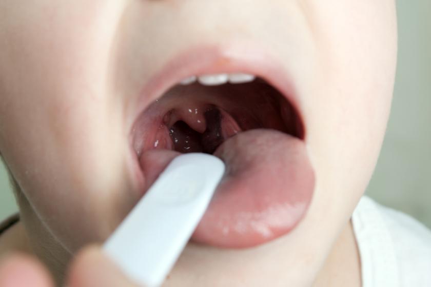 Tonsil Anak