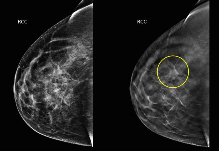 tanda-kanser-payudara-mammogram-semua-semua-semuanya