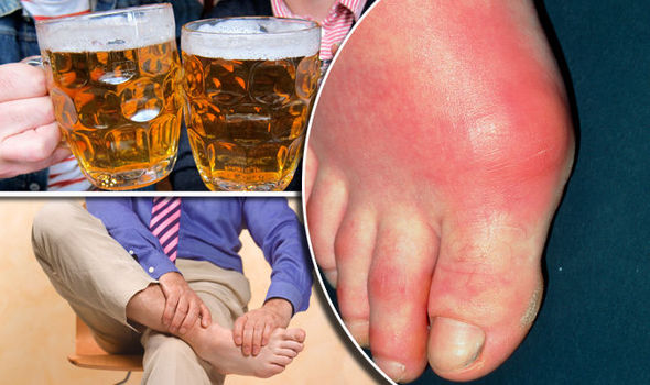 Gout Diet Beer Is High In Purines And Can Make Gout Symptoms Worse 814221